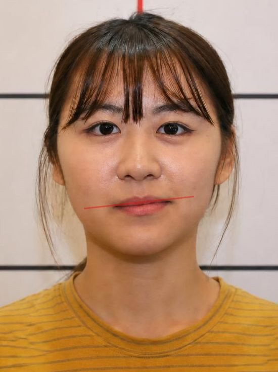 안면비대칭 교정 치료 전 사진