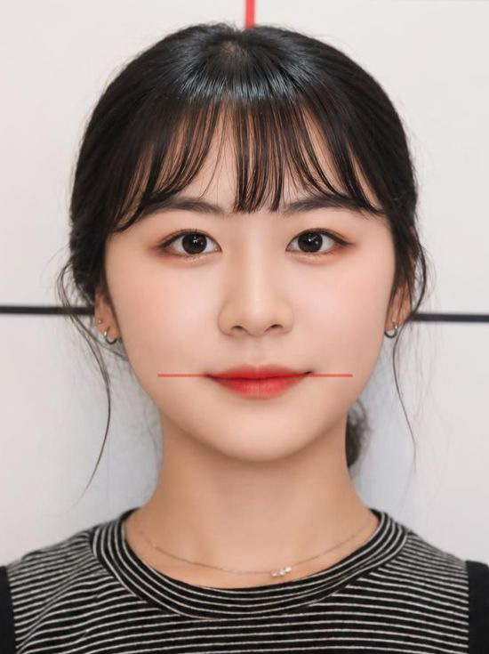 안면비대칭 교정 치료 후 사진