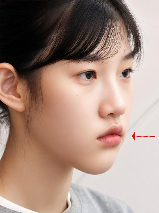 주걱턱 교정 후