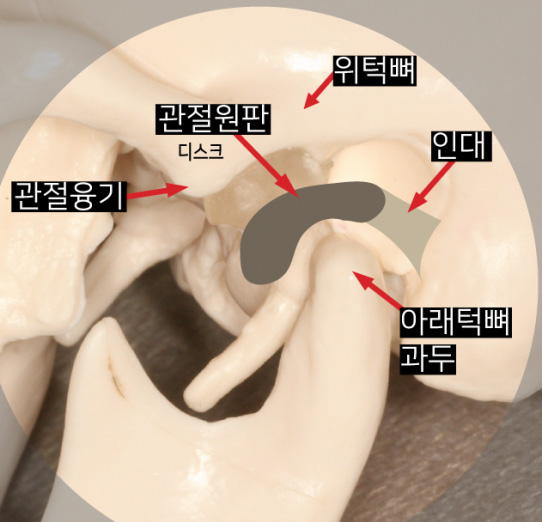 관절융기, 관절원판, 위턱뼈, 인대, 아래턱뼈 과두