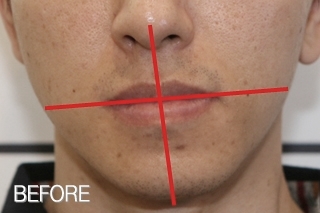 안면비대칭, 주걱턱 상태에서 비수술골격교정 (턱교정+치아교정) 치료 전