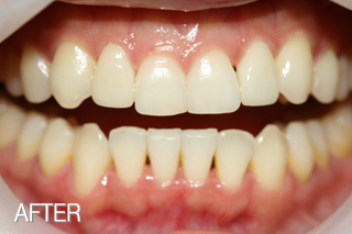왜소치 올세라믹으로 자연스러운 치아형성 치료 후