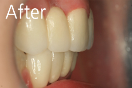 돌출 앞니성형/치아성형-올세라믹 치료 후