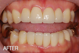 올세라믹전후 : 치아사이구멍, 치아뿌리노출 해결/돌출 앞니 올세라믹 치료 후