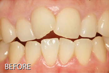 앞니 치아성형 전후/치아 올세라믹 증례 - 돌출되고 겹친 치아 올세라믹(치아성형) 치료 전