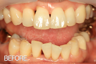 올세라믹전후 : 치아사이구멍, 치아뿌리노출 해결/돌출 앞니 올세라믹 치료 전