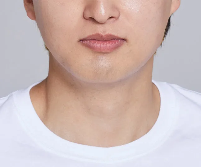 반대교합과 안면비대칭 교정 후, 2024.03 촬영